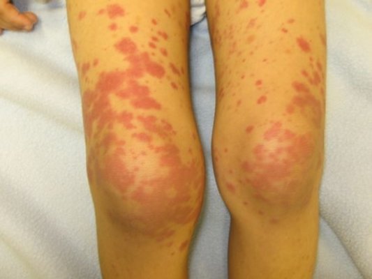 vörös foltok jelentek meg a lábak bőrén pikkelysömör kezelés hasznos ételek