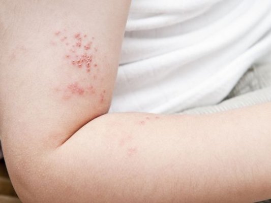 A bőr Erysipelas - az erysipelas népi jogorvoslatok kezelése