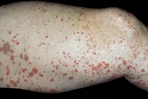 Piros foltok a bőrön - Bőrbetegségek